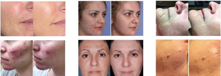 LED-Gesichtslicht Infrarot-LED-Therapie PDT-LED-Professionelle-Maschine Bio-Photomodulation-LED-Fototherapie-Licht 4